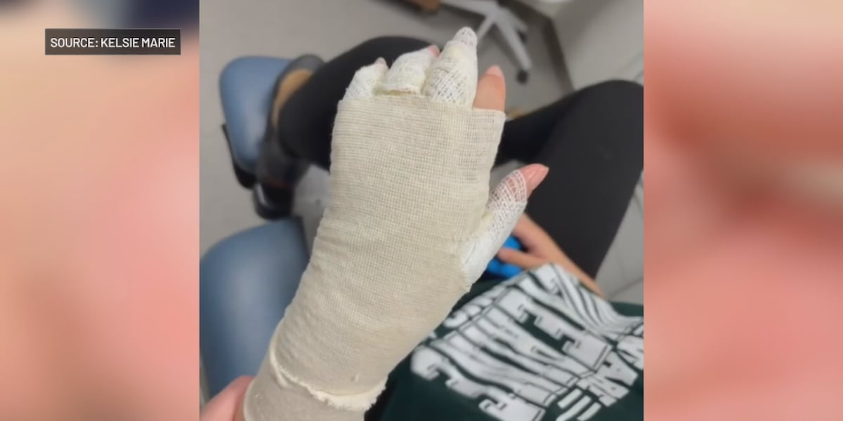 Viral online ‘NeeDoh’ challenge leaves Cleveland child with severe burns