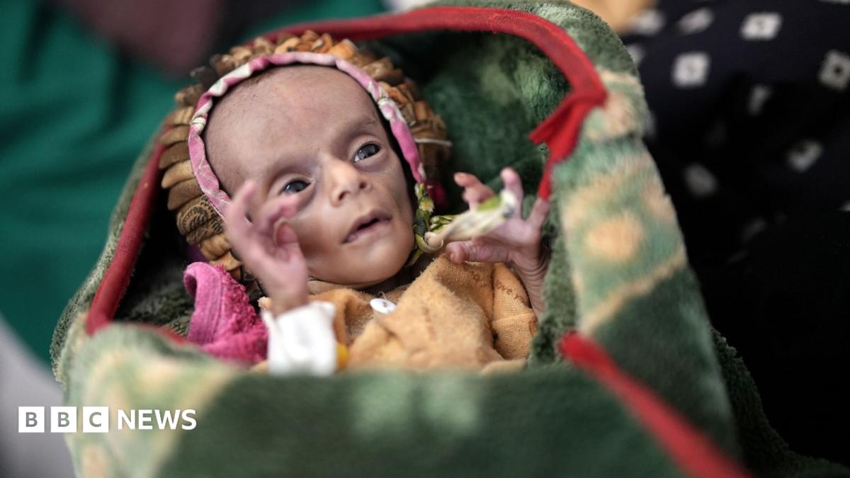 Newborn twins fight for survival as conflict fuels Yemen’s hunger crisis